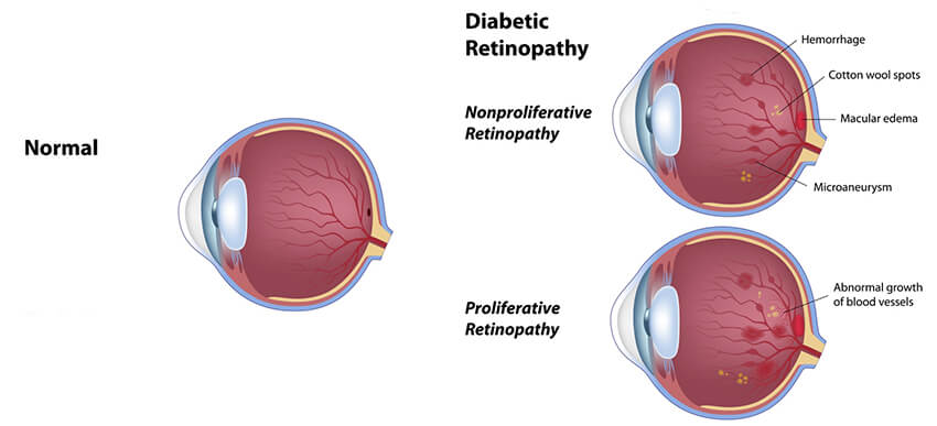 Diabetic Retinopathy Chart