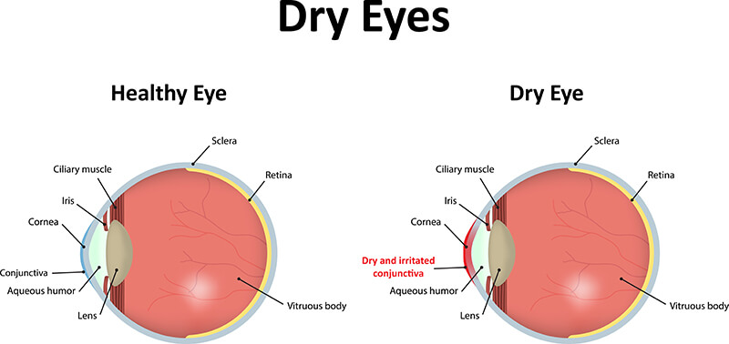 Dry Eye