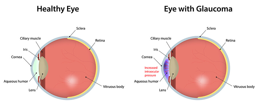 Glaucoma